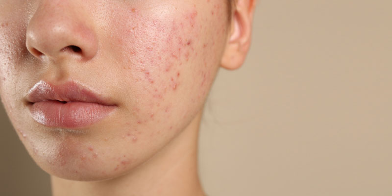 جوش های قرمز و ملتهب روی پوست صورت