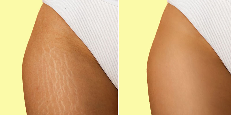 مقایسه قبل و بعد درمان ترک های پوستی