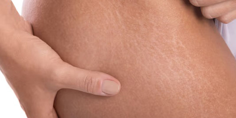 عکس نزدیک از خطوط استرچ مارک روی پوست