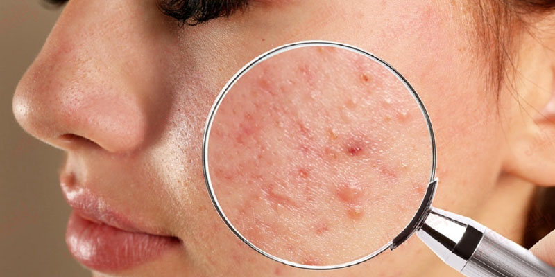 در حال بررسی پوست و مشاوره درمان جوش