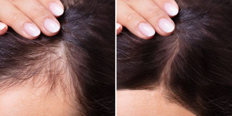 تصویر قبل و بعد از مزوتراپی مو برای افزایش تراکم و ضخامت مو