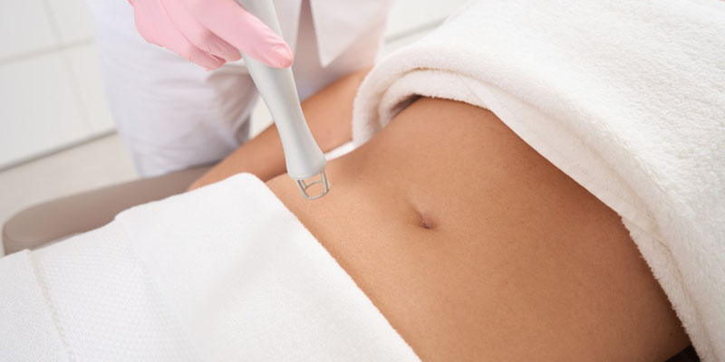 انجام میکرونیدلینگ یا لیزر درمانی برای ترک های پوستی در کلینیک