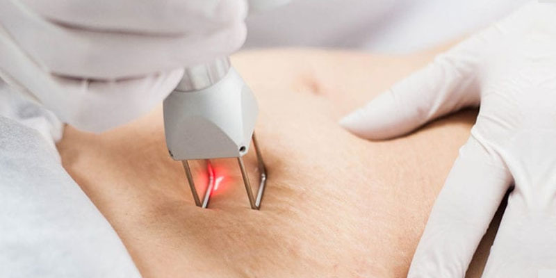 پزشک در حال معاینه و مشاوره پوست برای استرچ مارک