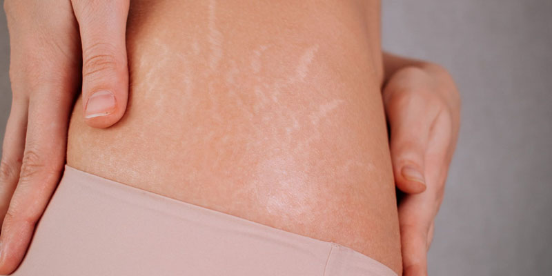 استرچ مارک روی شکم و ران در نواحی معمول ایجاد آن