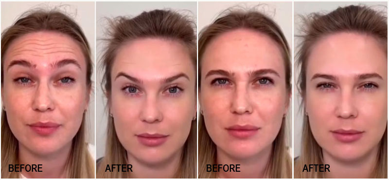 نتیجه تزریق بوتاکس برای کاهش چین و چروک صورت قبل و بعد
