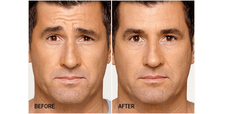 پوست صاف و بدون چین و چروک بعد از تزریق بوتاکس